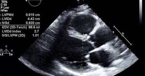 Cost of 2D Echo Test for Heart Disease – Medical Pinas.